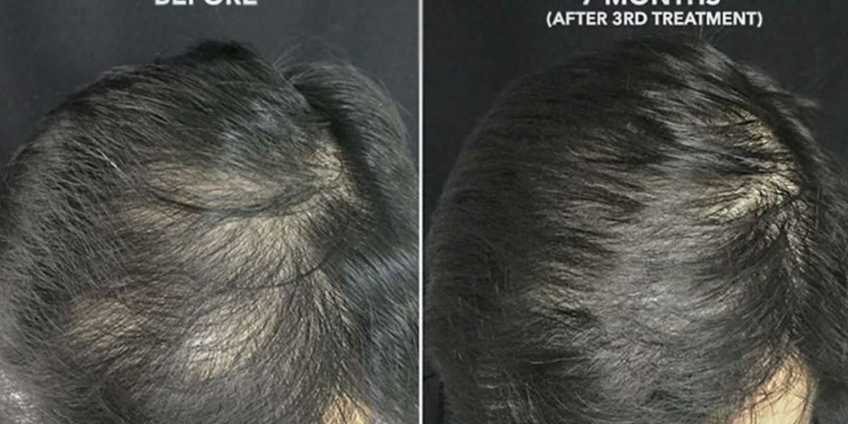 Prp hair treatment