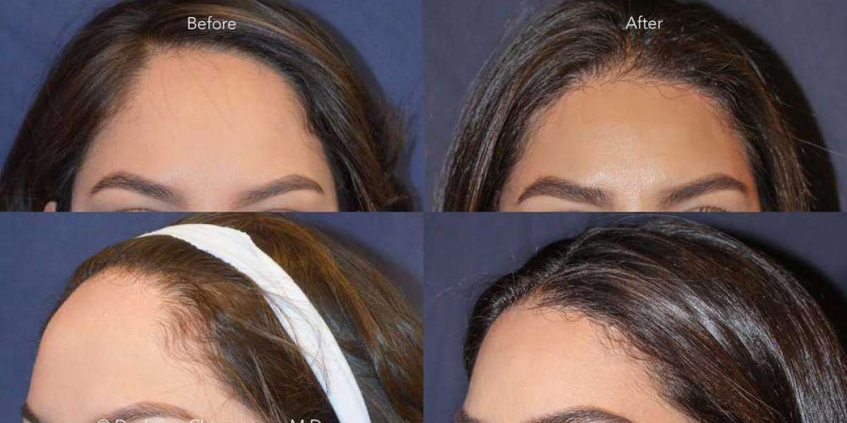 Hairline Surgery