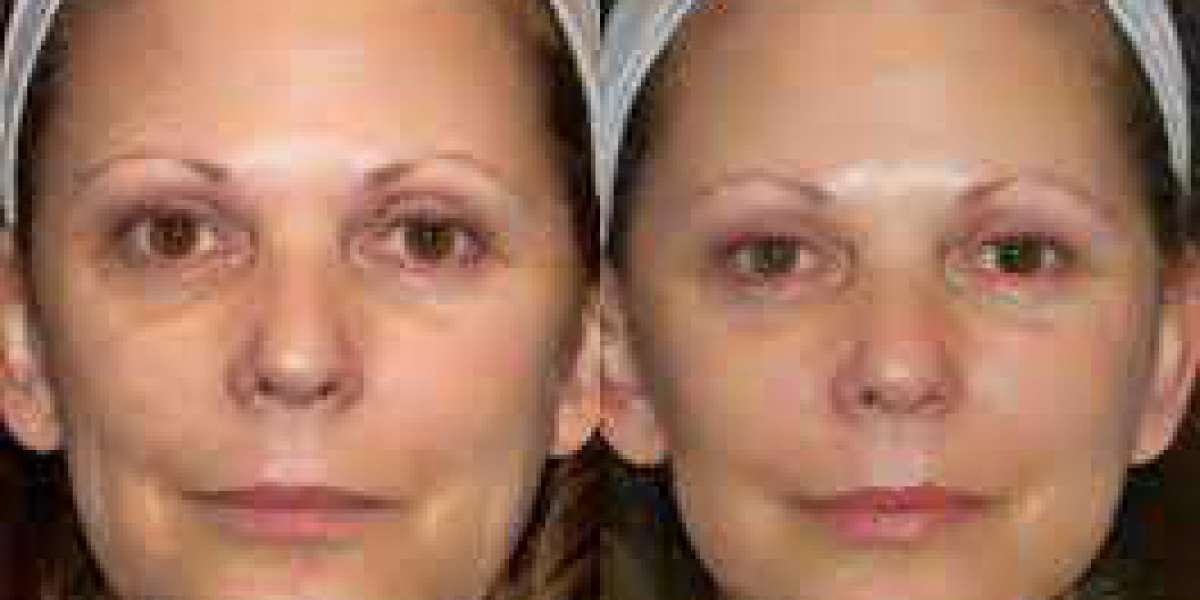 Scarlet Microneedling With Radiofrequency (RF)