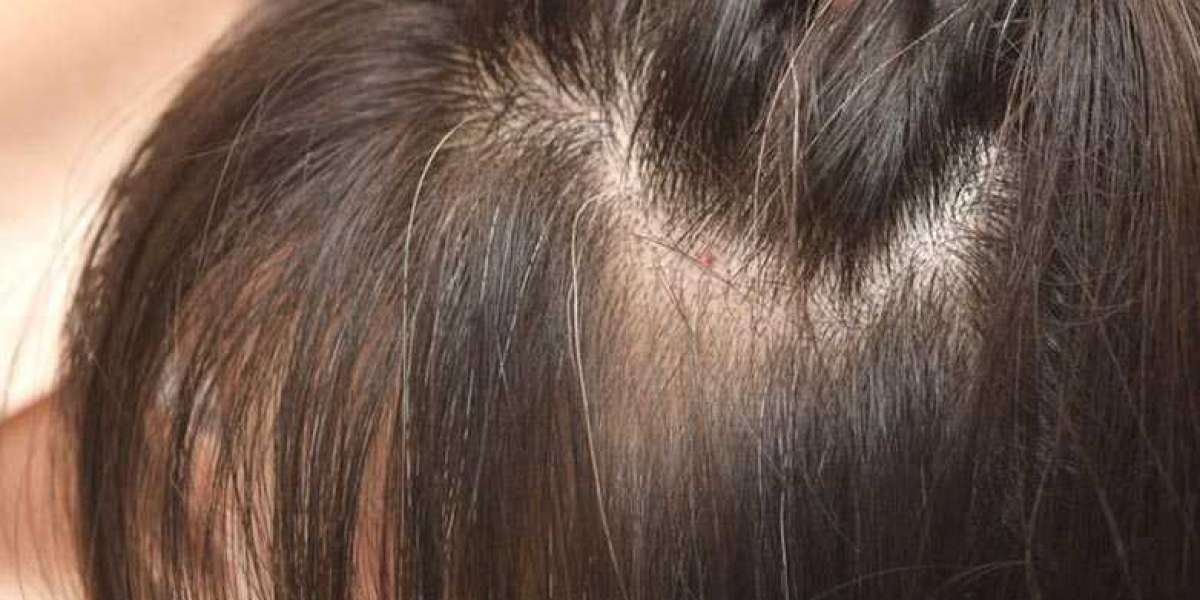 A COMPLETE GUIDE TO SCALP MICROPIGMENTATION HAIRLINES