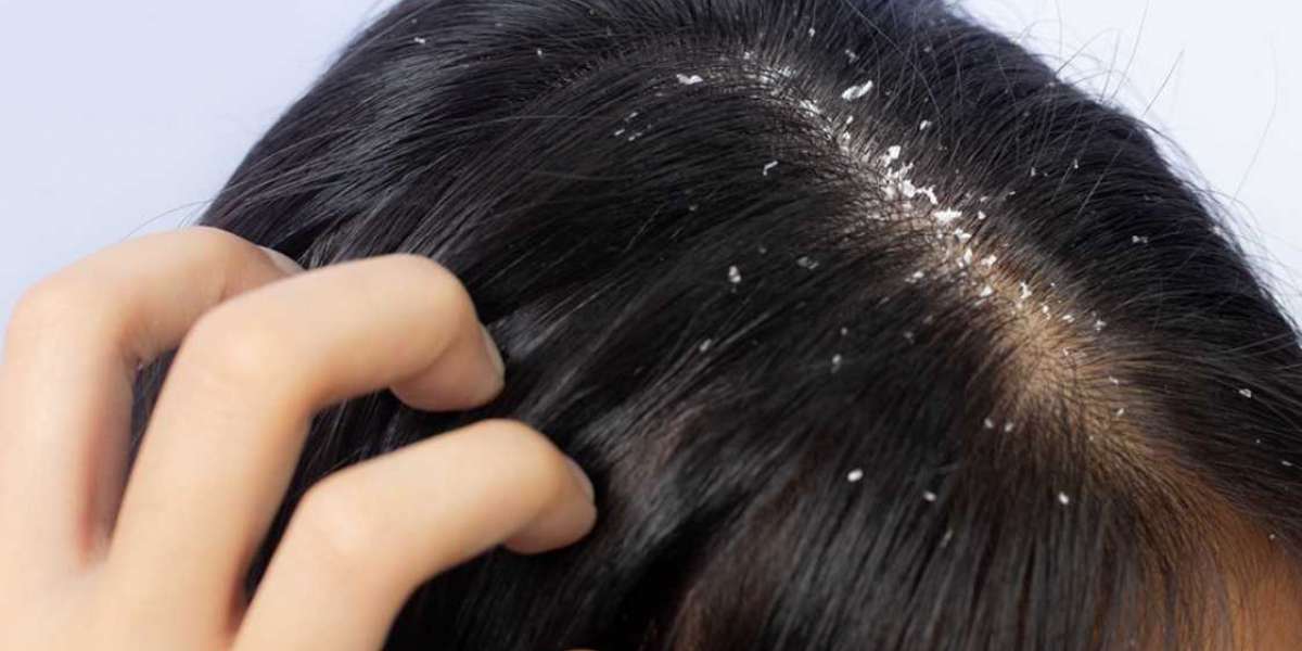 Essential Oils for Anti-Dandruff Treatment: A Natural Solution
