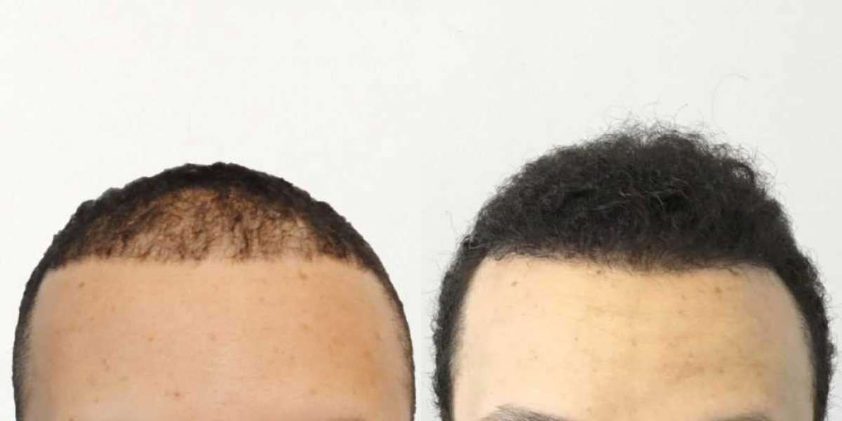 SmartGraft Hair Restoration