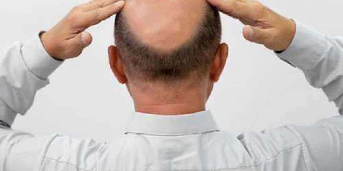 Best PRP Hair Treatment in Gurgaon - Dr. Paul's Advanced Hair and Skin Solutions
