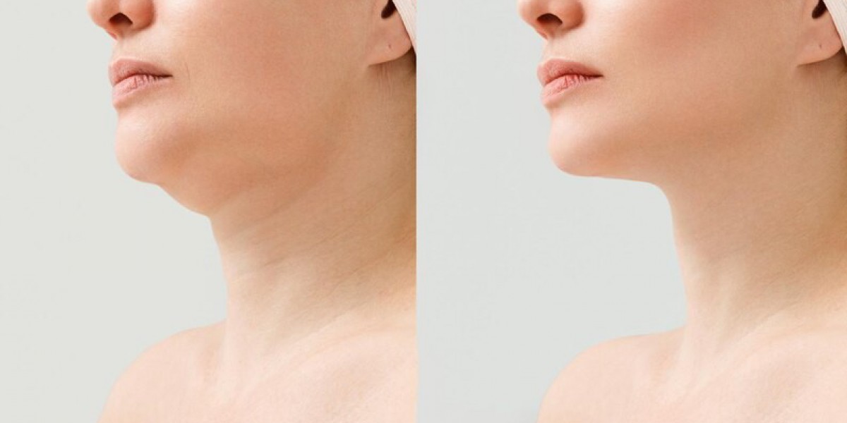 Enhance Your Facial Contours with Chin and Jawline Fillers at On The Glow Medical Spa