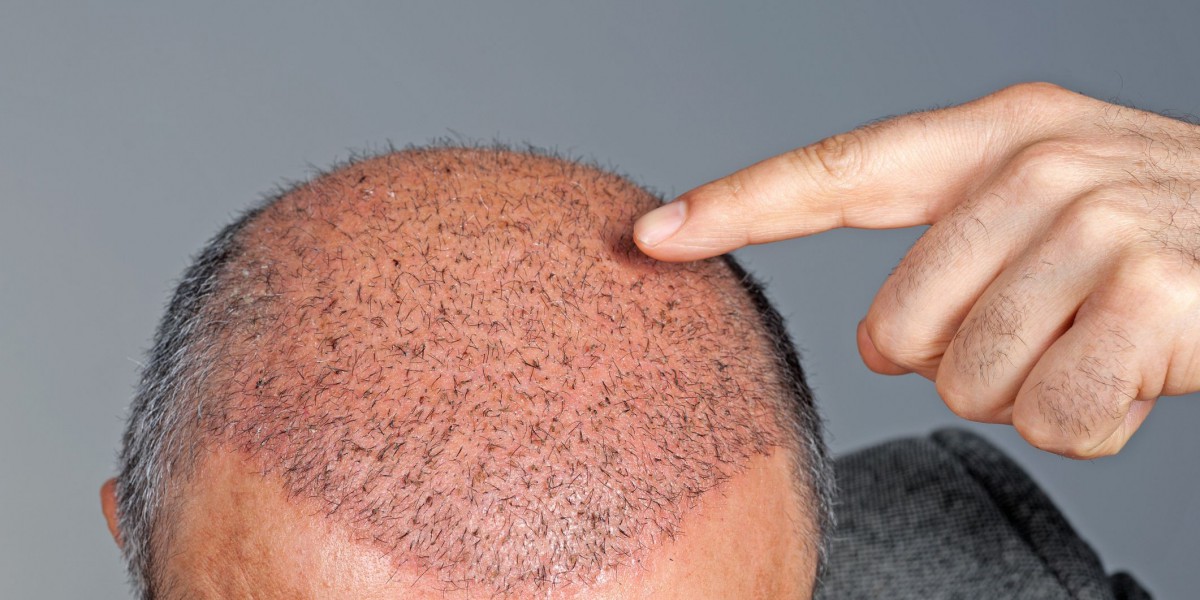 Revive Your Hairline with Scalp Micropigmentation: A Solution Worth Exploring