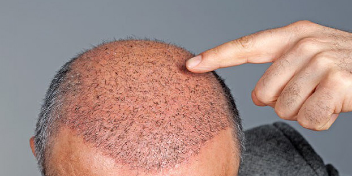 A New Beginning The Journey of Hair Transplantation