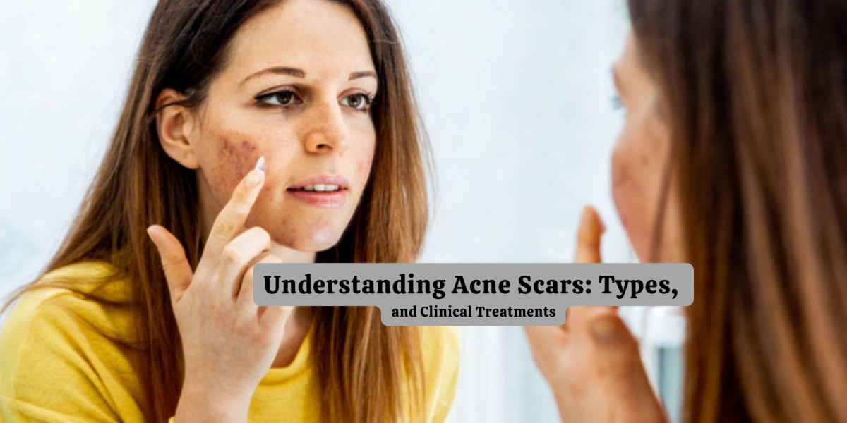 Understanding Acne Scars: Types, and Clinical Treatments