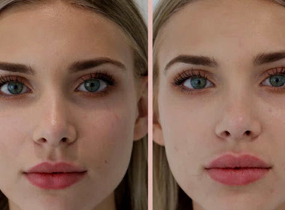 How do You Augment Lips in the Best Skin & Vein Centre by Using the Best 1 ml Lip Filler? – NYC Newsly