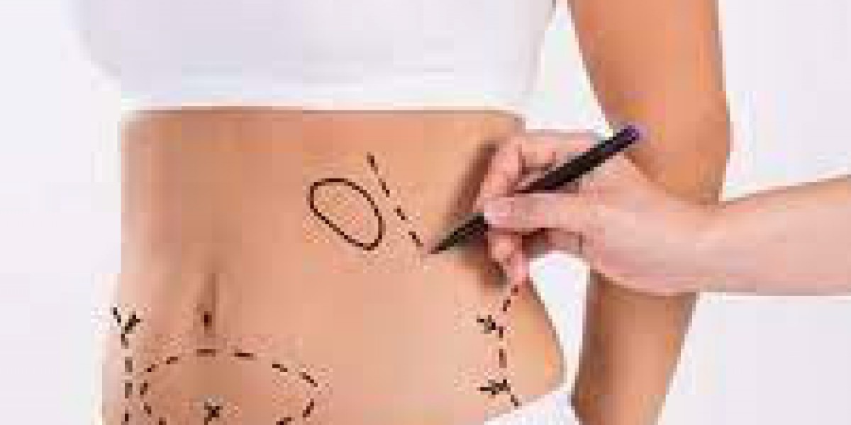 From Consultation to Aftercare: A Step-by-Step Guide to Liposuction in Riyadh