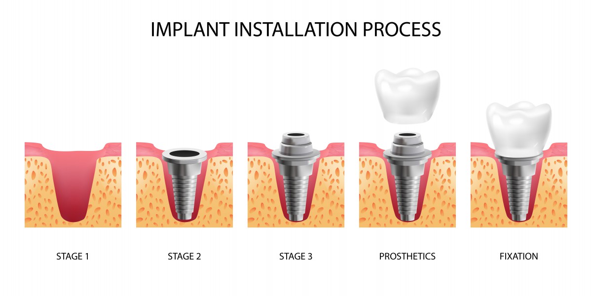 Get a Full Arch of Teeth in One Day With All-on-4 Dental Implants