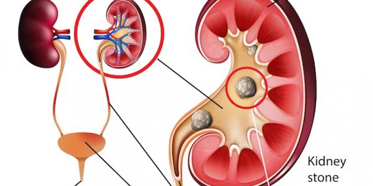 How Do You Get Relief From Kidney Stones?