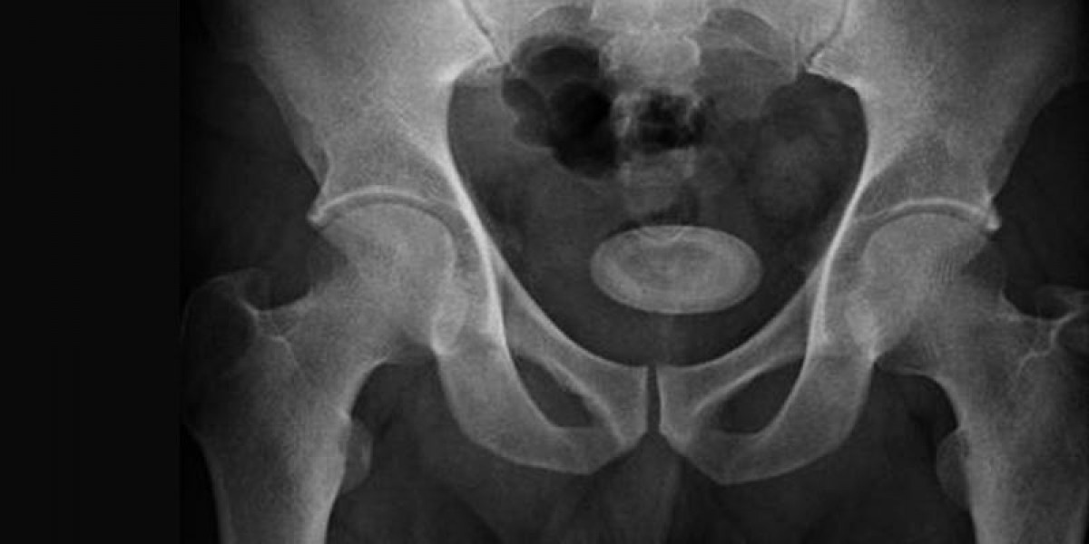 What Are The First Signs of Bladder Stones?