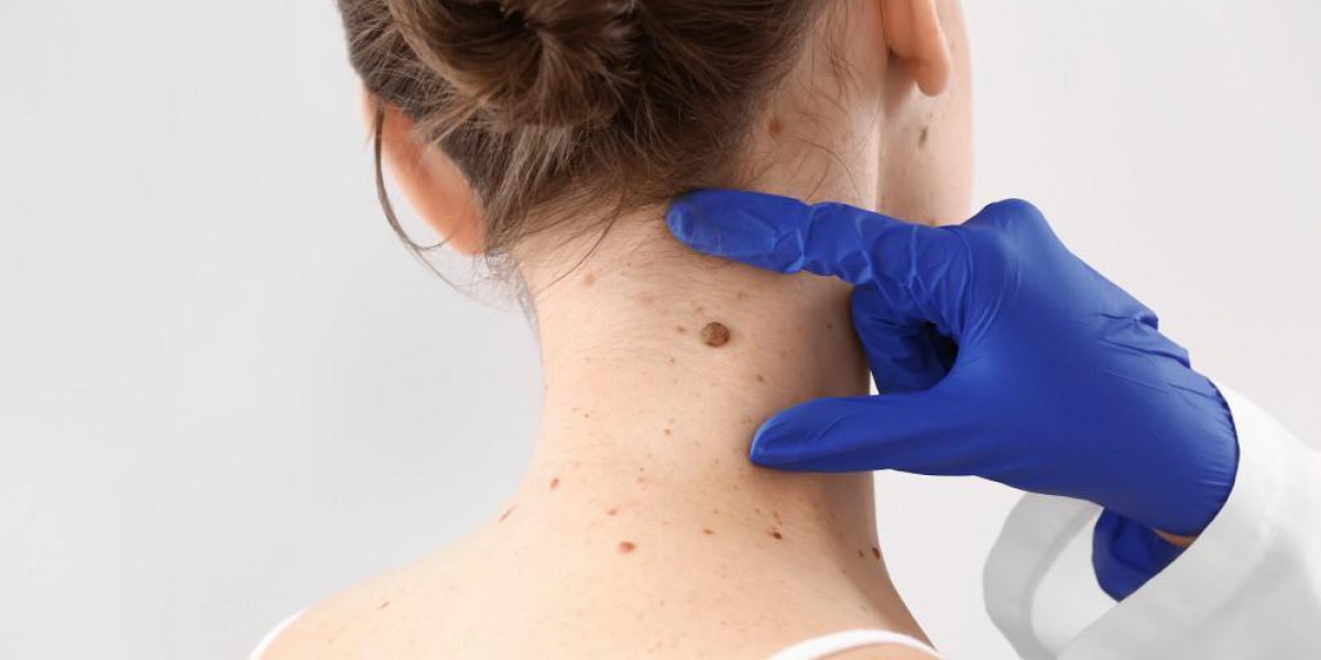 DIY Neck Skin Tag Removal: Safe and Simple Methods
